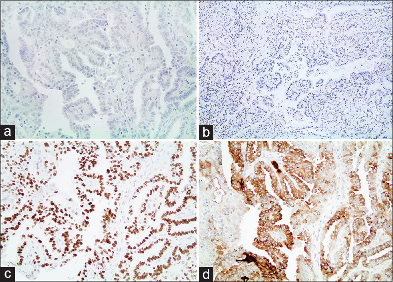 (a) Papillary thyroid carcinoma component with negative immunostaining for p63. (b) Papillary thyroid carcinoma component with negative immunostaining for cytokeratin 5/6. (c) Papillary thyroid carcinoma component with positive immunostaining for thyroid transcription factor-1. (d) Papillary thyroid carcinoma component with positive immunostaining for thyroglobulin