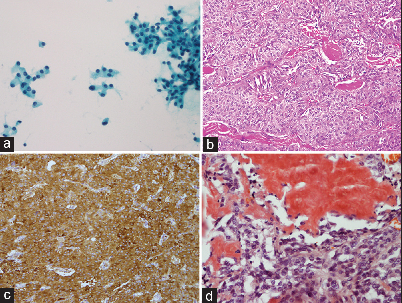 Medullary thyroid carcinoma. (a) There is a loose group of cells with relatively uniform nuclei; occasional larger nuclei with prominent nucleoli are present. Tumor cells have plasmacytoid appearance (smear, Papanicolaou stain). (b) Low-power microscopic view showing highly vascularized tumor with trabecular pattern of growth and deposition of amyloid (hematoxylin-eosin, original magnifications ×200). (c) Immunostain for chromogranin. The tumor cells are uniformly reactive. (d) Amyloid stains orange-red with the Congo red stain