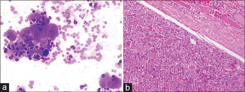 Follicular adenoma, Hürthle cell type. (a) The aspirate consists of a pure population of Hürthle cells in small, crowded groups and as isolated cells in a background that lacks colloid and lymphocytes. The cells are highly variable in size and amount of cytoplasm (smear, Diff-Quik stain). (b) The tumor is completely surrounded by a thin fibrous capsule. Predominant microfollicular pattern, nuclei are round, uniform, and nonoverlapping. The component cells have deeply eosinophilic, granular cytoplasm (hematoxylin-eosin, original magnifications ×200)