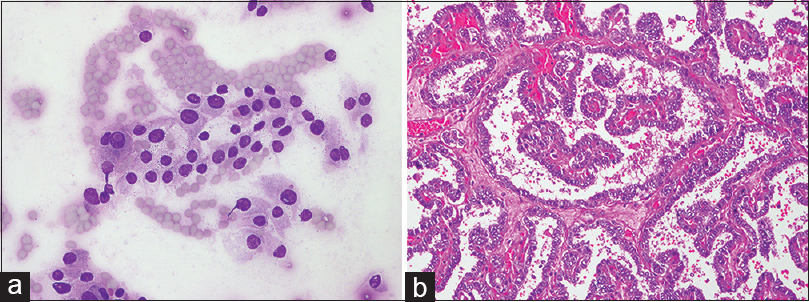 Papillary thyroid carcinoma. (a) Intranuclear cytoplasmic pseudoinclusions and nuclear grooves are shown. The remaining nuclei show variation in size and shape (smear, Diff-Quik stain). (b) Complex branching papillary architecture. The papillae are covered by epithelium with disturbed polarity. Nuclear enlargement, overlapping, irregular nuclear contour, and clearing are seen (hematoxylin-eosin, original magnifications ×200)