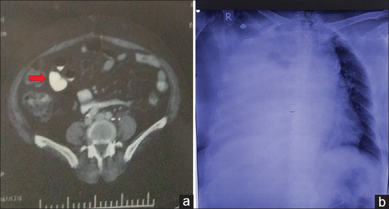 (a) Contrast-enhanced computed tomography abdomen showing heterogeneously enhancing mass along left internal iliac group of vessels; (b) chest X-ray posteroanterior view with massive right-sided pleural effusion