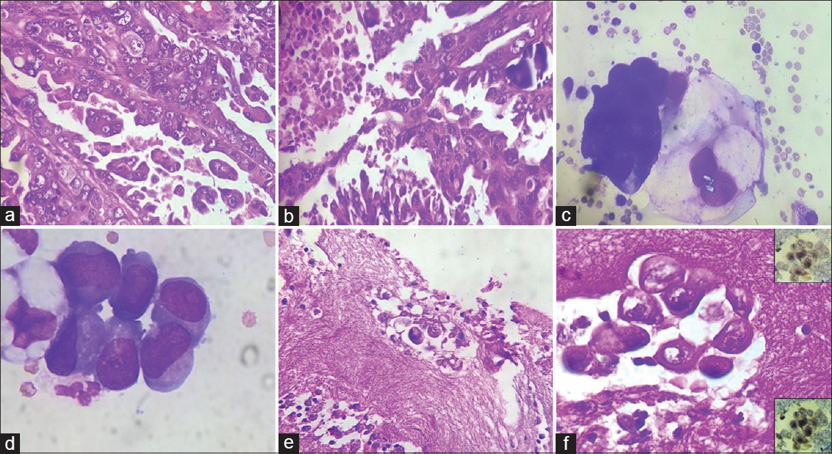 (a and b) Sections showing papillary serous carcinoma (a, H and E, ×400) with necrosis and calcification (b, H and E, ×400); (c and d) smears from pleural fluid revealing cluster of atypical cells in three-dimensional cluster with tumor cells showing marked pleomorphism, high nucleocytoplasmic ratio, irregular nuclear membrane, hyperchromatic nuclei, prominent nucleoli, and moderate amount of pale cytoplasm (c, Giemsa, ×1000); few with cytoplasmic vacuolation (d, Giemsa, ×1000); (E and F) cell block showing focal cluster of malignant epithelial cells (H and E; e, ×400 and f, ×1000) and estrogen receptor and progesterone receptor positivity (f, right upper and lower insets)