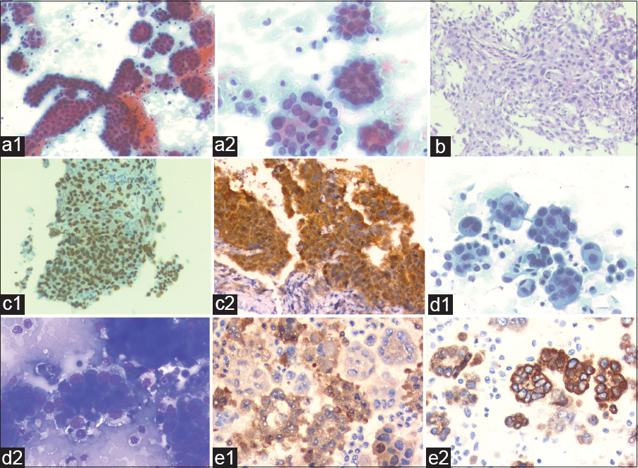 (a1 and a2) The pleural fluid smears were very cellular comprising of three-dimensional papillaroid and tubular clusters of malignant cells. The tumor cells showed moderate pleomorphism, clumped chromatin, and prominent nucleoli. In addition, numerous mitotic figures were also noted (Papanicolaou stain). (b) Pleural biopsy showed pleomorphic tumor cells arranged in tubulopapillary and glandular pattern along with fibrocollagenous tissue (hematoxylin and eosin stain). (c1 and c2) Immunohistochemistry showed nuclear positivity for WT1 and nuclear and cytoplasmic staining for Calretinin. (d1) Ascitic fluid smears were highly cellular with formation of cell balls having knobby contours. In higher magnification, features such as cell-in-cell engulfment, giant atypical mesothelial cells were seen. (Papanicolaou stain). (d2) Irregularly distributed variable sized cytoplasmic vacuoles were also seen (May Grunwald Giemsa stain). (e1 and e2) Immunohistochemical stain done on cell block from ascitic fluid sample showing positive staining for calretinin and CK5/6