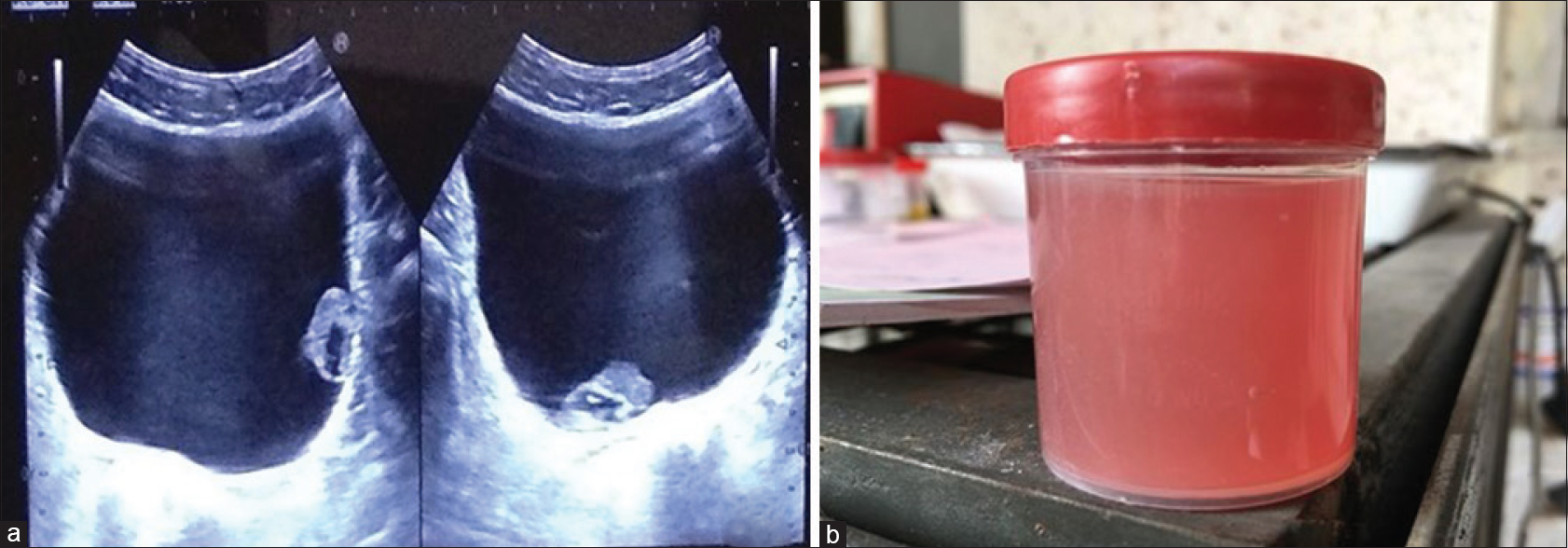 (a) Ultrasonography abdomen showing distended urinary bladder with hetero-echoic lesion in the lumen. (b) Gross image of achylous thin reddish-brown urine sample from the patient presenting with hematuria