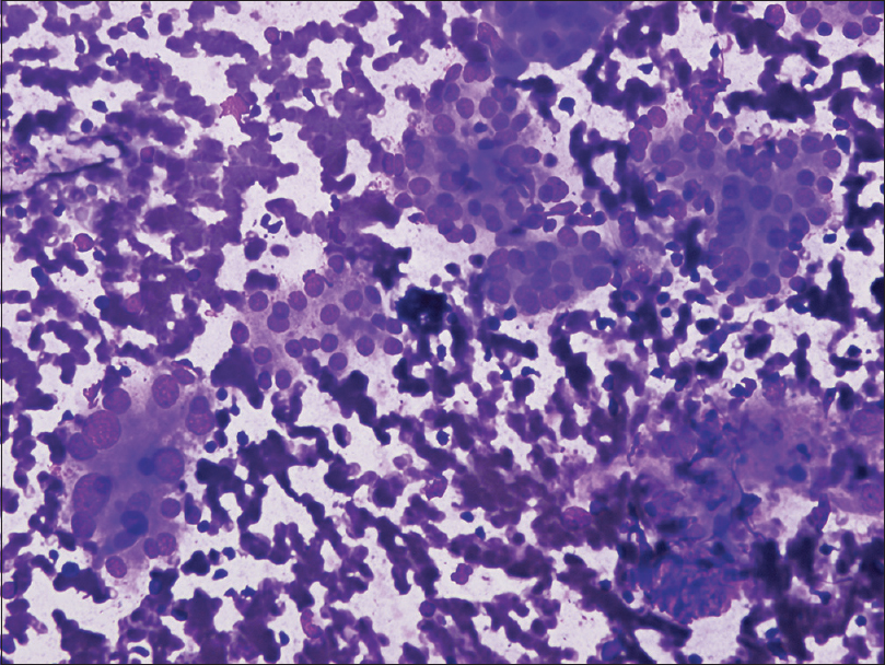 Atypia of undetermined significance (patient with history of Hashimoto's thyroiditis). Oncocytic follicular cells show nuclear enlargement (Smear, May-Grünwald Giemsa stain, ×40)