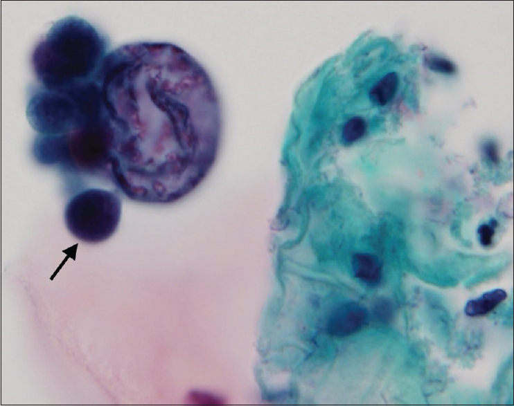 Liquid-based cervical sample: Cokeromyces recurvatus showing “daughter” buds (arrow) arrayed partially around the center cell (ThinPrep, Papincolaou, ×100)