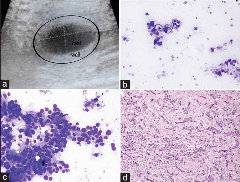 (a) Sonographic image of the cystic breast lesion. (b) Cyst content with macrophages (Diff Quik©, ×400). (c) Aspirate from the wall showing malignant ductal cells (Diff Quik©, ×400). (d) Surgical tissue reveals infiltrating ductal carcinoma (H and E, ×200)