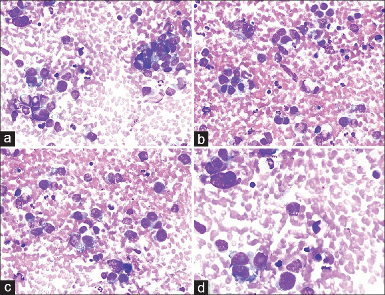 (a-d) Various smears of fine needle aspiration showing moderately pleomorphic tumor cells with large nuclei, vacuolated cytoplasm and visible nucleoli (a: Diff Quik©, ×200; b-d: Diff Quik©, ×400)
