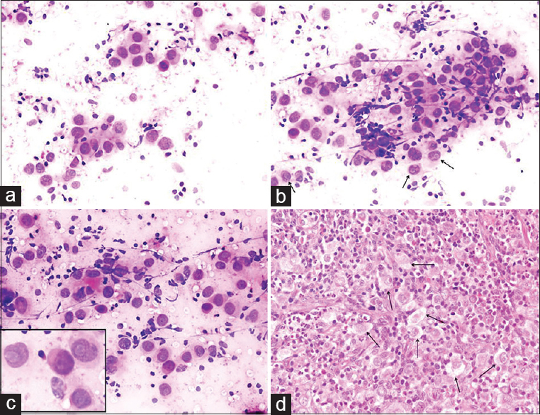 (a-c) Cervical lymph node aspirate showing clusters of mono- and bi-nucleated large cells containing large, pale, vacuolated cytoplasm and vesicular nuclei with demarcated prominent nucleoli (arrows) (inset to show lacunar cells with macronucleoli) (Diff Quik©, ×200). (d) Histopathologic section displaying several lacunar cells (arrows) (H and E, ×200)