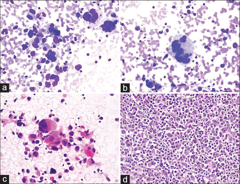 (a-c) Aspiration cytology smears reveal multinucleated, bizarrely shaped tumor cells mixed with large and small lymphocytes (a: Diff Quik©, ×200; b: Diff Quik©, ×400; c: Pap, ×200). (d) Surgical biopsy of the lymph node confirmed anaplastic large cell lymphoma