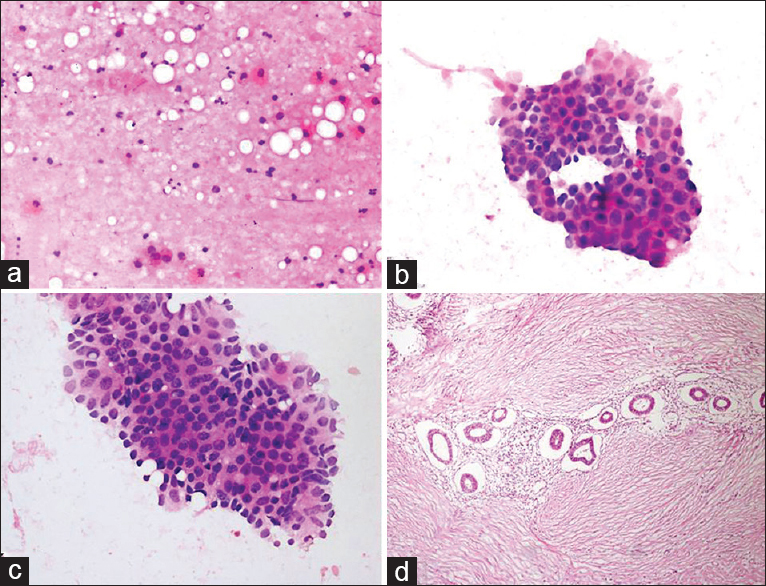 (a) Smear showing cystic background with occasional histiocytes (H and E, ×200). (b and c) Cytology reveals an aggregate of glandular epithelial cells with nuclear enlargement, hyperchromasia and anisonucleosis (Diff Quik©, ×200 and × 400). (d) Histology showed proliferative endometrial glands in the lymphocytic fibrous stroma (H and E, ×200)