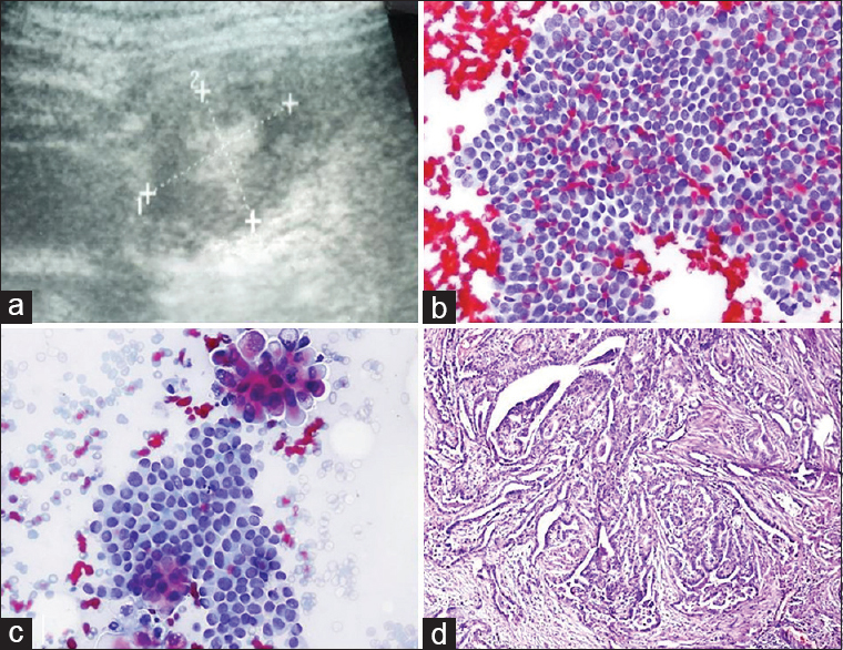 (a) Ultrasound image of the thyroid nodule with central calcification. (b and c) Fine-needle cytology findings are consistent with papillary carcinoma (Pap, ×200 and × 400). (d) Histopathologic examination of the nodule confirmed the diagnosis of papillary carcinoma (Pap, ×200)