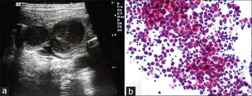 (a) Sonogram of the cervical chain shows hypoechoic enlarged lymph nodes. (b) Aspiration from the dominant neck lymph node presented homogenous monomorphic lymphoid infiltration composed of atypical large cells (Pap, ×200)