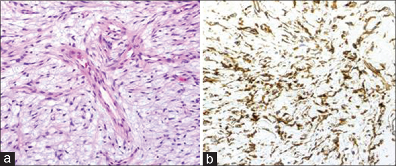 (a) Histologically, the spindle tumor cells had proliferated haphazardly, and thin-walled capillaries were also evident (H and E, ×200); (b) Immunohistochemical study revealed a positive result for STAT6 (×200)