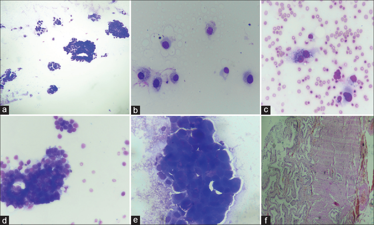 (a-c) A case of xanthogranulomatous cholecystitis which on fine-needle aspiration cytology was kept in diagnostic Category 3 showed cellular smears with cells having nuclei with minimal anisonucleosis, bland chromatin, inconspicuous nucleoli, and foamy cytoplasm. (May Grunwald Giemsa, ×10, ×40). (d-f) fine-needle aspiration cytology of the gallbladder led to false-positive diagnosis of Category 4 in a case which later histopathologically proved to be adenomatous hyperplasia (f). The smears were cellular, showed moderate pleomorphism but close examination of nuclei showed mostly uniform chromatin (May Grunwald Giemsa, ×40; H and E, ×20)