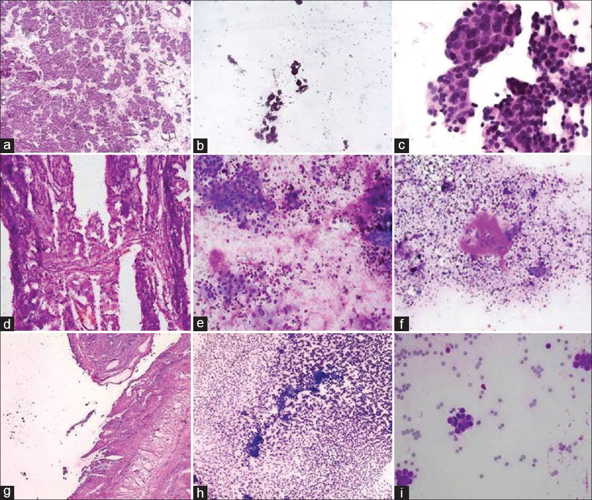 (a) Solid serous carcinoma frozen section slide. (b and c) Papillary structures with high-grade cells cytology imprint. (d) Clear cell carcinoma frozen section slide. (e and f) High-grade cells with hyaline background. (g) Granulosa cell tumor frozen section slide. (h and i) Bland uniform nuclei and Call-Exner bodies’ cytology imprint