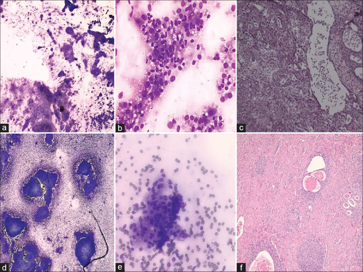 (a and b) Endometrioid tumor of the ovary - cohesive groups of columnar cells. (c) Corresponding frozen section shows no squamous morules. (d) Brenner tumor - cellular smear of cohesive clusters. (e) High power shows uniform cells with low nuclear-cytoplasmic ratio (f) Corresponding permanent section of Brenner tumor