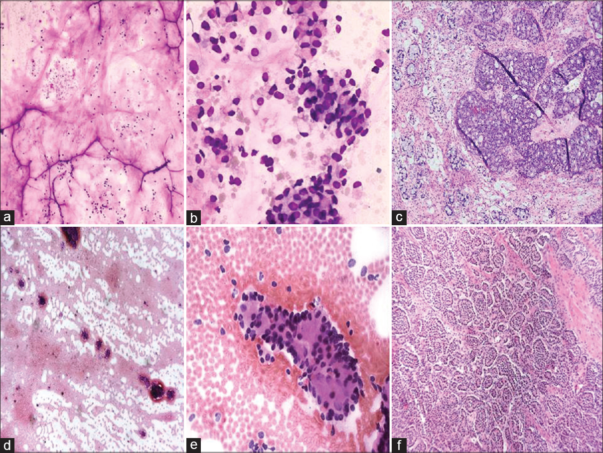 (a and b) Abundant mucin and signet cells are unusual features for primary ovarian cancer. (c) Corresponding section shows metastatic adenocarcinoma arising from appendiceal primary. (d and e) The smears show moderately cellular smears with fine “salt-and-pepper” chromatin. (f) Corresponding section of metastatic neuroendocrine tumor