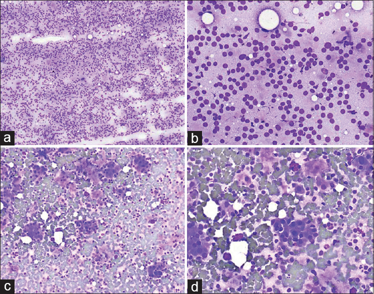 The smears from a 44-year-old male patient with a right parotid mass showed cellular smears with mostly single cells (a: Diff-Quik, ×100; b: Diff-Quik, ×400). Other areas of the smears showed some clusters of epithelial cells (c: Diff-Quik, ×100; d: Diff-Quik, ×400). The primary pathologist misinterpreted the background single cells as lymphocytes and misdiagnosed as “oncocytic neoplasm, favor Warthin tumor.” The follow-up surgical resection was acinic cell carcinoma