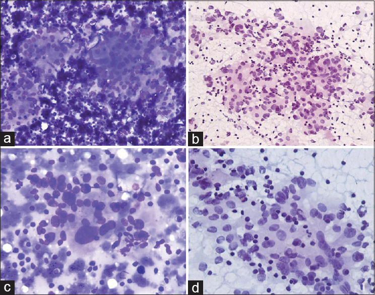 Fine-needle aspiration cytology. (a and b) Cellular smears showing loose cohesive clusters of tumor cells with acinar follicular pattern in a background of reactive lymphoid cells (a: MGG, ×100; b: PAP, ×100). (c) High power showing round-to-oval nucleus with moderate anisonucleosis and bizarre cell (MGG, ×400). (d) Tumor cell showing fine nuclear chromatin and moderate-to-abundant fragile cytoplasm and lymphocyte sprinkling (PAP, ×400)