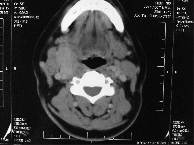 Contrast-enhanced computerized tomography showing a lobulated, ill-marginated enhancing space occupying lesion in the right carotid bifurcation