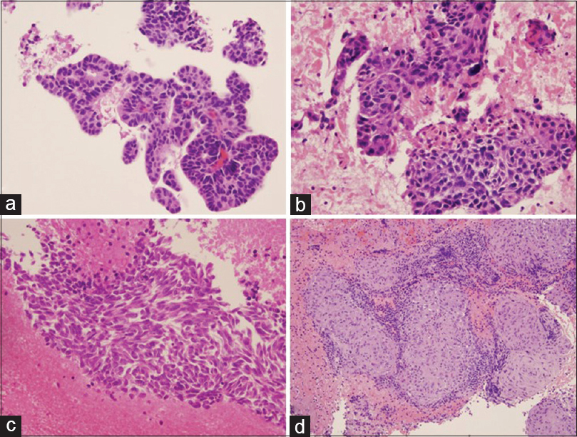 Cytological diagnosis of lung nodules. (a) Primary lung adenocarcinoma. Tumor cells show acinar and glandular arrangement with hyperchromatic nuclei. (b) Primary lung squamous cell carcinoma. Tumor cells demonstrate pleomorphic nuclei with few dyskeratotic cells. (c) Primary lung small cell carcinoma. Tumor cells reveal fine chromatin pattern, nuclear crowding and molding, and tumor necrosis. (d) Granulomatous inflammation. The section reveals clusters of epithelioid histiocytes, scattered multinucleated giant cells, and inflammatory cells. All photos are taken from cellblock H and E preparations at ×20