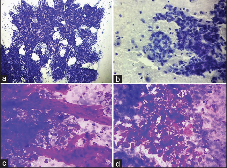 (a-d) Smears showing high cellularity comprising atypical epithelial cells arranged in papillae (a; Pap, ×200), clusters, glandular pattern (b; Pap, ×400), groups as well as singly scattered showing prominent vascularity (c; Giemsa, ×400). Cells are round to oval with moderate pleomorphism, marked overlapping, and overcrowding with hyperchromatic to coarsely granular chromatin (c), inconspicuous to evident nucleoli and a moderate amount of finely vacuolated cytoplasm (d; Giemsa, ×400)