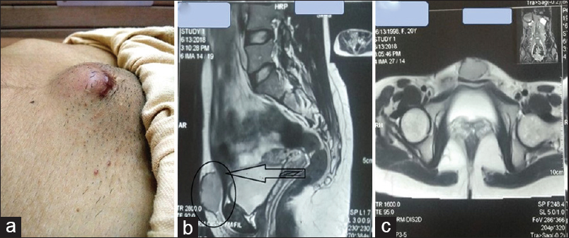 (a and c) A photograph showing an enlarged subcutaneous mass in the suprapubic region. (b and c) MRI of the pelvis and abdomen showing a well-defined subcutaneous midline heterogeneously enhancing suprapubic mass measuring 40 mm × 35 mm × 22 mm