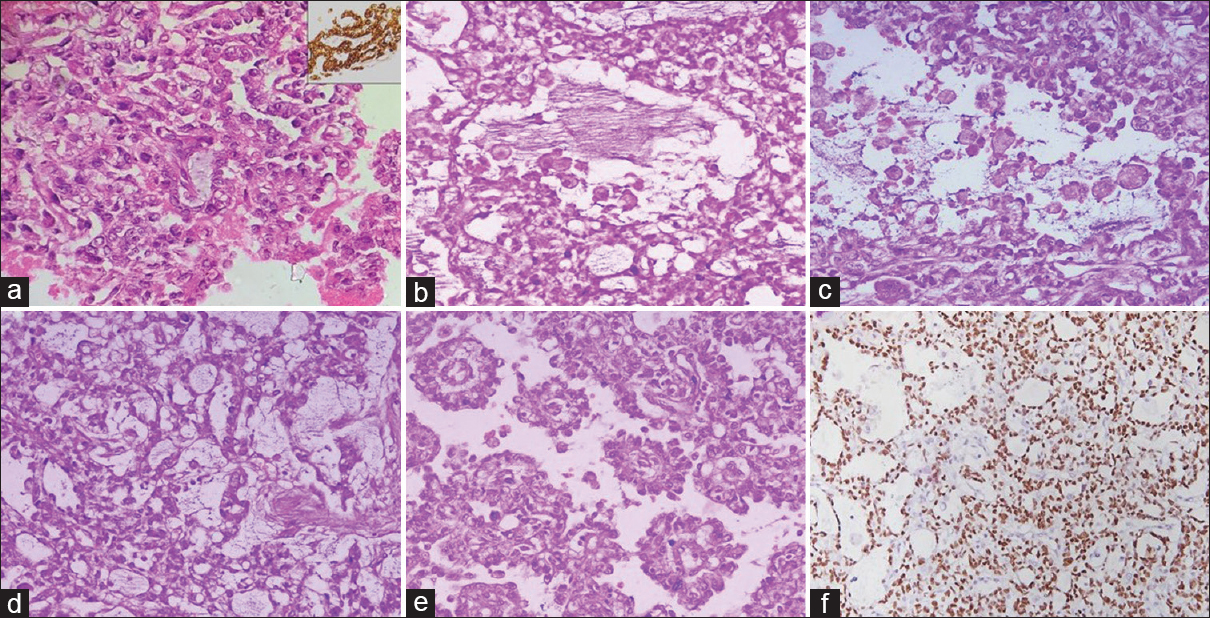 (a-f) Cell block section showing atypical epithelial cells in the glandular pattern (a; H and E, ×400) and showing strong panCK positivity (a, inset). (b and c) Sections showing atypical epithelial cells in glandular pattern with many foamy cells (b and c; H and E, ×400). (d and e) Tumor cells in a reticular pattern (d; H and E, ×400) and many Schiller–Duval bodies (e; H and E, ×400). (f) Image showing tumor cells with strong SALL4 positivity (IHC, ×200)