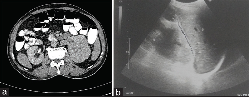 (a) Contrast-enhanced computed tomography abdomen showing right renal mass with lobulated heterogeneously enhancing lesion involving upper pole; (b) Ultrasonography abdomen showed enlarged right kidney with hypoechoic mass