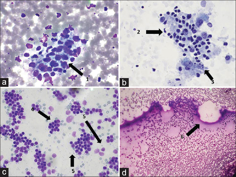 (a) DQ stain, ×60, (b) PAP stain, ×60, (c) DQ stain, ×60, (d) DQ stain, ×60. (1) Follicular cells with paravacuolar granules. (2) Lymphohistiocytic tangles. (3) Tingible-body macrophages. (4) Predominance of polymorphic lymphocytes. (5) Lymphoglandular bodies in the background. (6) Occasional pass showed some watery colloid