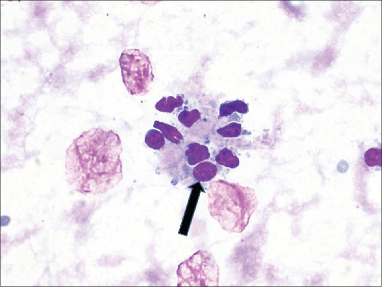 Arrow depicts Hurthle cells with round nuclei, prominent nucleoli, and granular cytoplasm (DQ stain, × 60)
