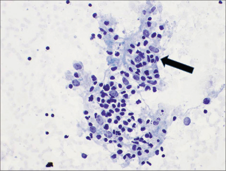 Arrow depicts lymphoepithelial structures (reactive thyroid follicular cells infiltrated by lymphocytes), pap stain × 60