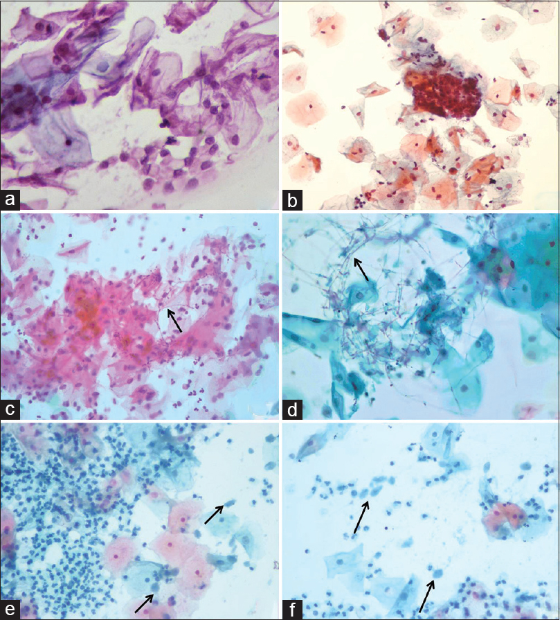 A panel of photomicrographs demonstrating conventional (a) and corresponding EziPREP™ smear (b) appearance of no intraepithelial lesion or malignancy or NILM. Conventional smear shows few fungal hyphae in a case of candidiasis (c) while the hyphae are seen more clearly in EziPREP™ smear in the same case (d). Only few scattered trophozoites of Trichomonas vaginalis are seen in conventional smear (e) compared to EziPREP™ smear showing numerous easily discernible trophozoites (f) (a-f: Pap, ×400)