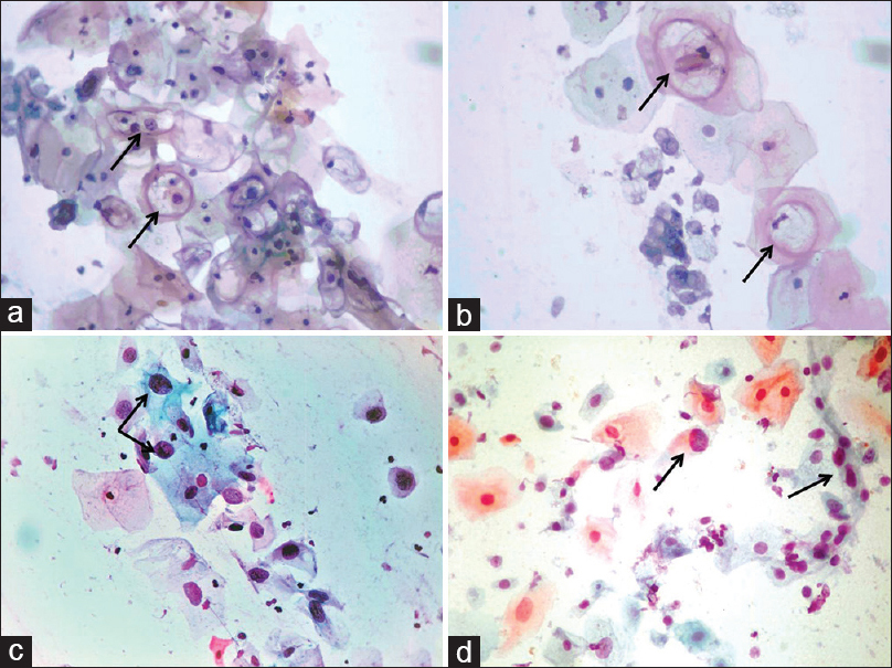Corresponding conventional (a) and EziPREP™ smears (b) showing similar features in a case of low-grade squamous intraepithelial lesion with HPV changes. A case of high-grade squamous intraepithelial lesion with atypical cells in conventional (c) and EziPREP™ smear (d) (a-d: Pap, ×400)