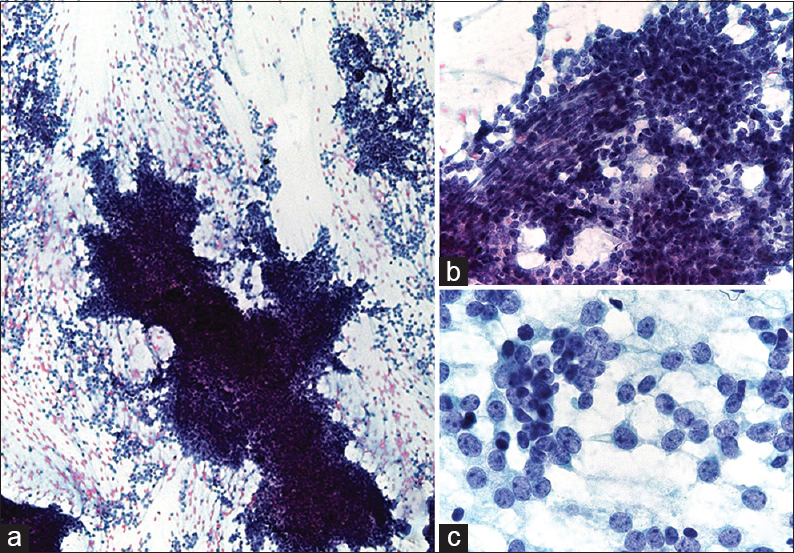 (a) The cytologic smear is hypercellular and consists of cell clusters with frayed edges and numerous single cells. (b) The cluster is composed of loosely cohesive, small, round to oval, and short spindle to spindle cells surrounding the capillary. The small round cells have scant cytoplasm with hyperchromatic and inconspicuous or absent nucleoli. (c) Most tumor cells are uniformly small, round to oval with high nuclear-cytoplasmic ratio. The nuclear chromatin is finely granular with several small nucleoli