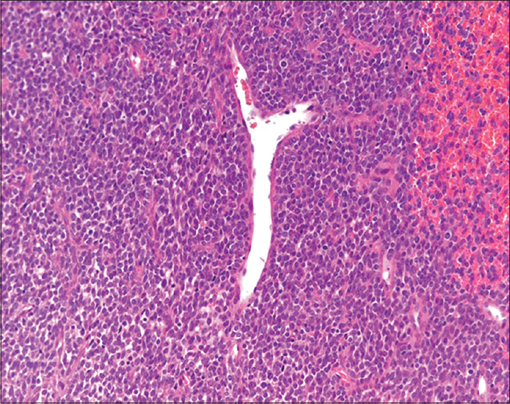 The small round cells and short-spindled cells showed an intersecting fascicular pattern. Focally, hemangiopericytomatous staghorn-like configurations were observed