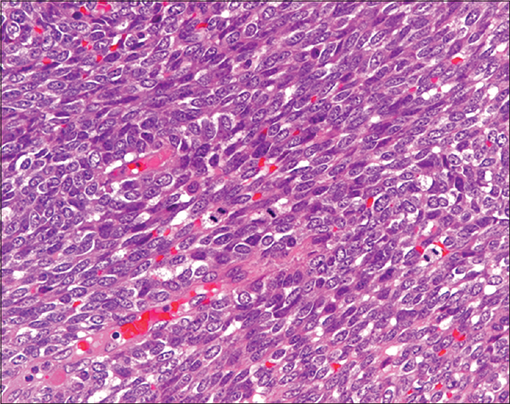 Small, oval to short-spindled cells with high nuclear-cytoplasmic ratio proliferate in a vaguely intersecting fascicular pattern. Mitotic figures are observed