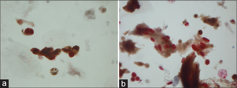 (a) Magnification, ×630. Dual staining of malignant urothelial cells: Ki-67 (nuclear red) and p16 (cytoplasmic and nuclear brown). (b) Magnification ×630. Dual staining of malignant urothelial cells: Ki-67 (nuclear red) and p16 (cytoplasmic and nuclear brown)