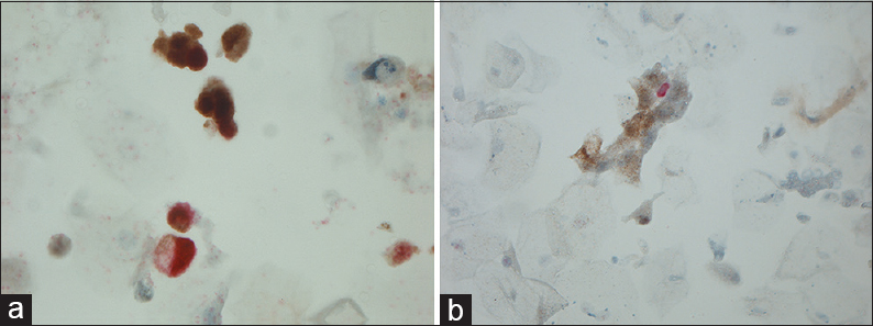 (a) Magnification, ×630. Positivity for both Ki-67 (red) and p16 (brown: nuclear and cytoplasmic) but not in the same cells. (b) Magnification, ×200. Positivity for both Ki-67 (red) and p16 (cytoplasmic) but not in the same cells