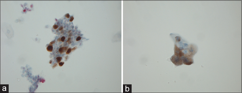 (a) Magnification, ×630. P16-positive urothelial cells with nuclear staining. (b) Magnification, ×630. P16-positive urothelial cells with cytoplasmic staining