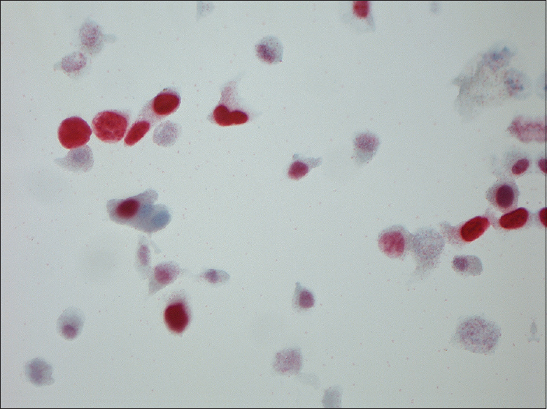 Magnification, ×630. Ki-67-positive urothelial cells