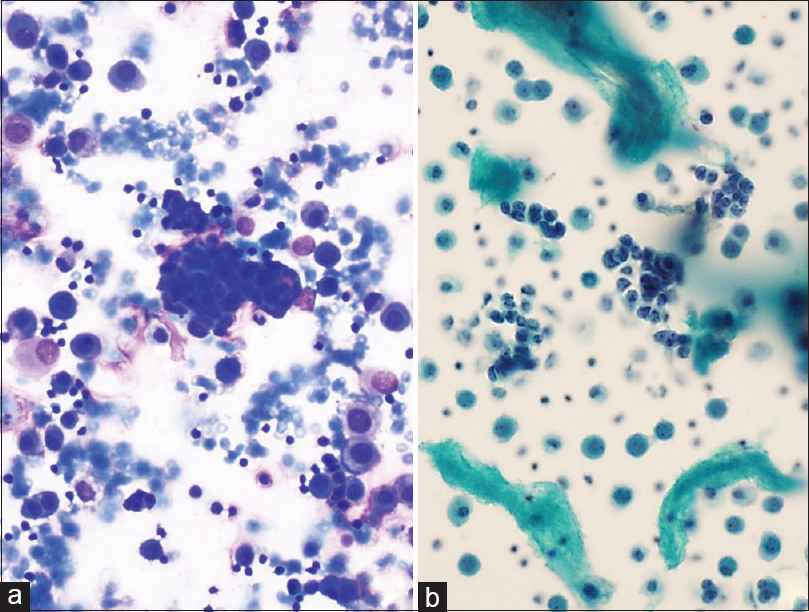 Similar tumor cells are noted within the pleural fluid effusion smears. Background showing mesothelial cells (a) MGG, ×200, (b) PAP, ×200