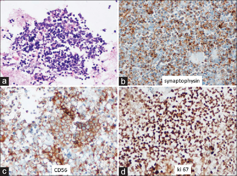 The cell block showing sheets and clusters of tumor cells (H and E, ×200) (a). The tumor cells are positive for synaptophysin and CD56 DAB, ×400 (b-c). Ki 67 index is >80% DAB, ×400) (d)