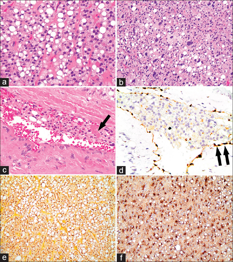 Histologic features of thyroid follicular carcinoma with signet ring cells. (a) Nested pattern of follicular cells, some with intracytoplasmic vacuoles imparting a signet ring cell appearance, and surrounding fine vasculature (H and E, ×400); (b) An area with marked cellular atypia (H and E, ×200). (c) Vascular invasion within the capsule, with fibrin thrombus formation associated with neoplastic follicular cells (arrow) (H and E, ×400). (d) ERG transcription factor immunohistochemistry, highlighting the endothelial cells (double arrows) lining the vascular space with neoplastic follicular cells within the lumen (×400). (e) Neoplastic cells negative for mucin (Mucicarmine, ×400). (f) Neoplastic cells positive for thyroglobulin (Thyroglobulin, ×200)