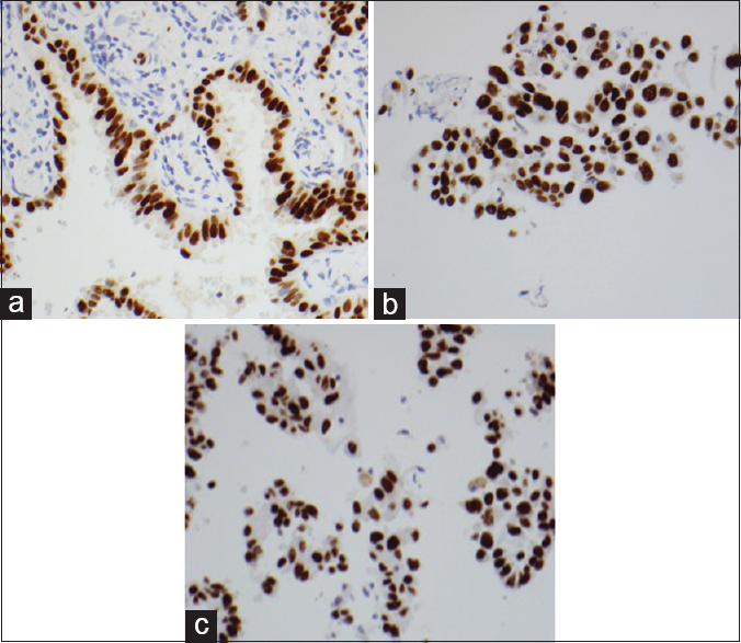 Equal intensity and proportional staining of TTF-1 in tumor cells, formalin-fixed paraffin-embedded, ×400 (a), cell blocks fixed in formalin, ×400 (b), and cell blocks fixed in alcohol, ×400 (c)