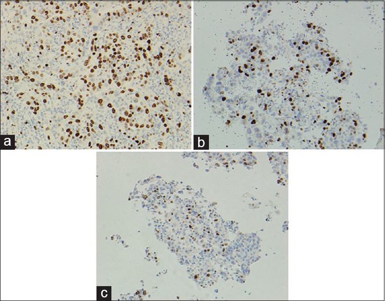 Difference in intensity and proportion of staining of Ki-67 in tumor cells, formalin-fixed paraffin-embedded, ×200 (a), cell blocks fixed in formalin, ×200 (b) and cell blocks fixed in alcohol, ×200 (c)