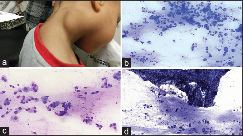 (a) Right-sided subcutaneous neck swelling, (b) scattered large cells with few binucleate forms in a background of proteinaceous material (Papanicolaou, ×200), (c) large polygonal cells with central to eccentric nucleus, prominent nucleoli, and abundant cytoplasm (Giemsa, ×400), (d) fragment of spindle cells with slender nuclei embedded in a matrix along with scattered large cells (Papanicolaou, ×200)