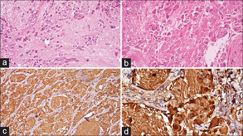 (a) Scattered ganglion cells in a Schwannian background (H and E, ×100), (b) mature and immature ganglion cells along with scattered lymphocytes (H and E, ×400), (c) synaptophysin positivity (×200), (d) S100 positive ganglion cells (×400)