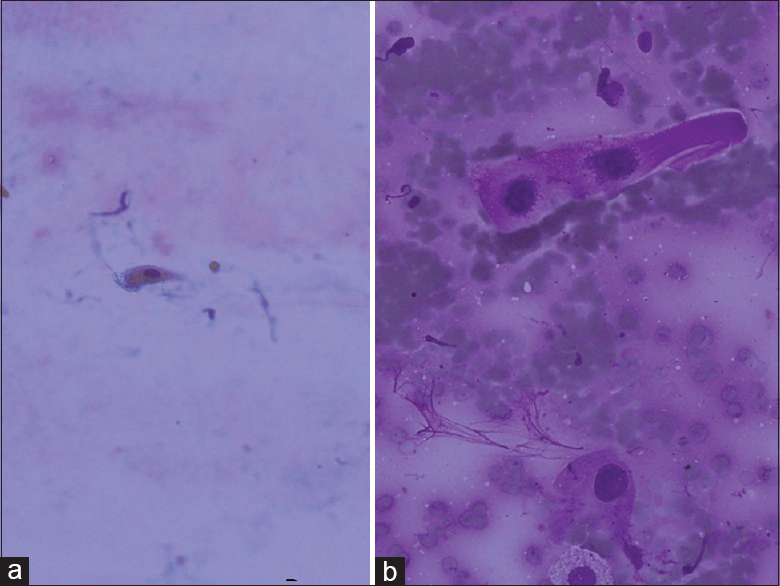 (a) Keratinized cell, PAP, ×20 (b) tad-pole cell. This cell seen as stretching of cytoplasm is typical for squamous cell carcinoma (Giemsa, ×40)